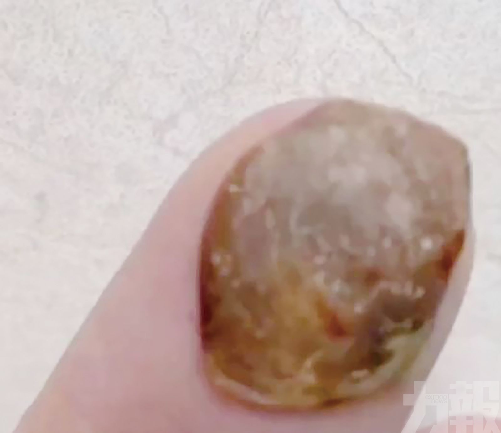 幼童嘴長「腫瘤」被要求開刀！